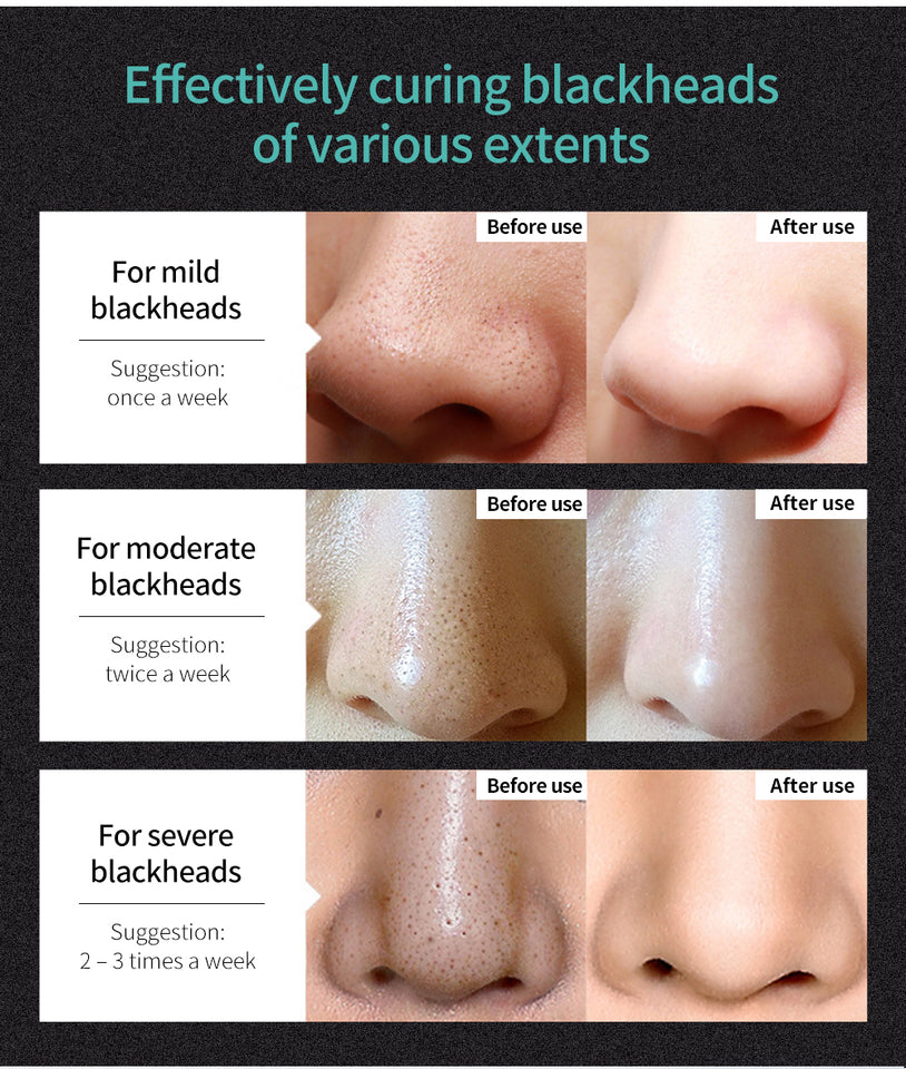 Korea Nose Blackhead Remover