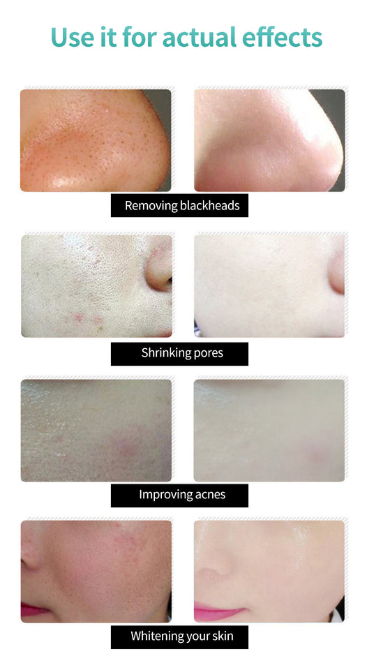 Korea Nose Blackhead Remover