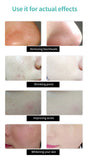 Korea Nose Blackhead Remover