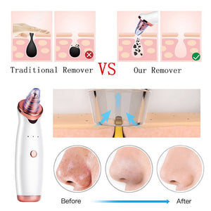 Facial Blackhead Remover