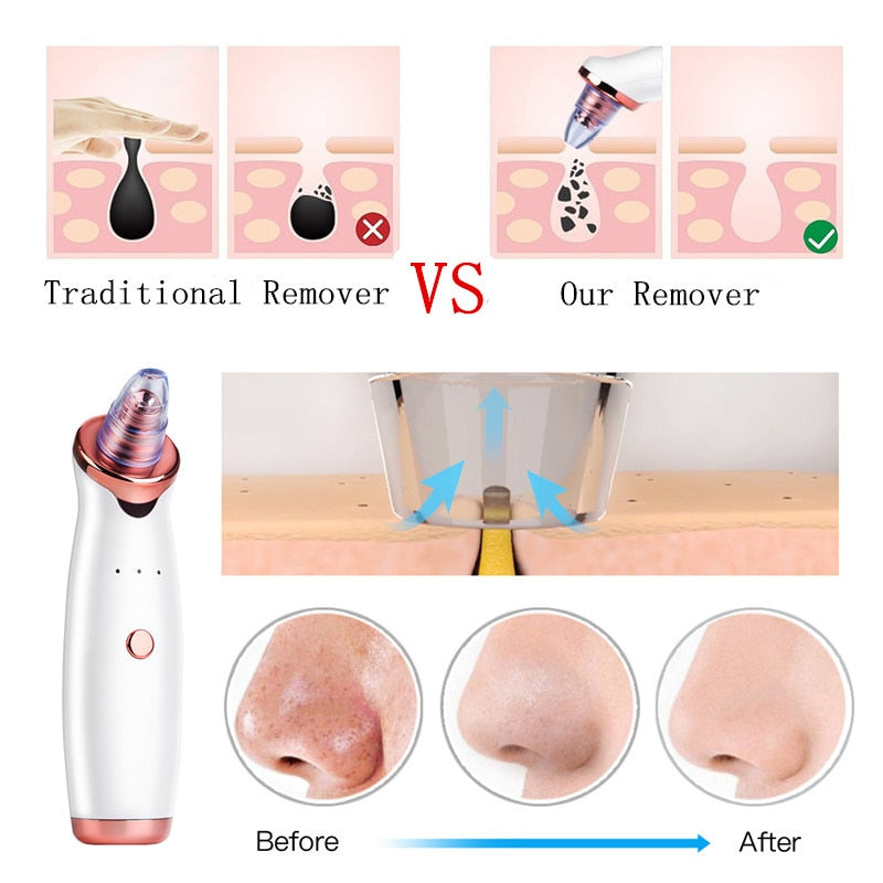 Facial Blackhead Remover